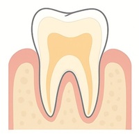 根面う蝕(こんめんうしょく)とは?