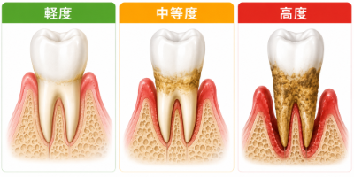 歯肉炎と歯周病の違いをご存じですか?