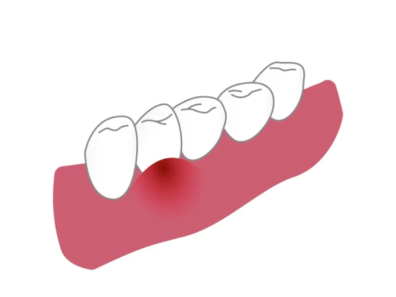 歯茎が腫れてきた